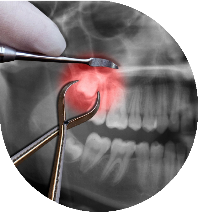 Wisdom Tooth Extraction